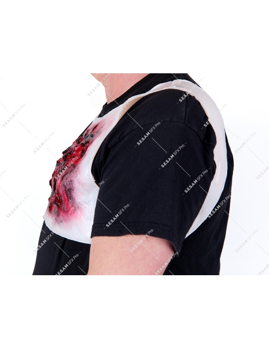 Brulure thermique thorax