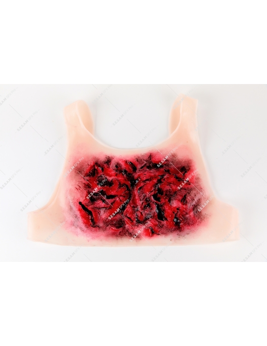 Brulure thermique thorax