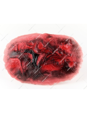 Brûlure thermique grave