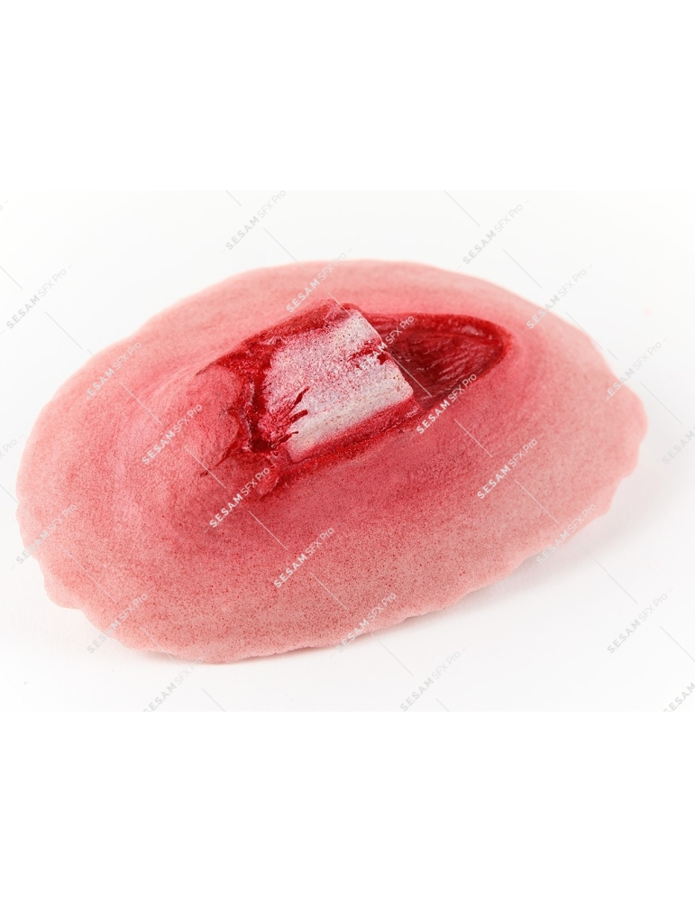 Fracture ouverte du tibia