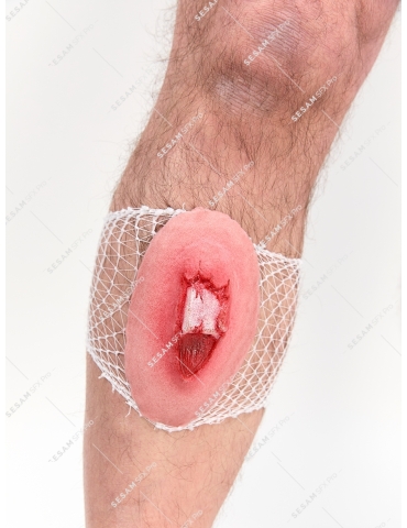 Fracture ouverte du tibia 2