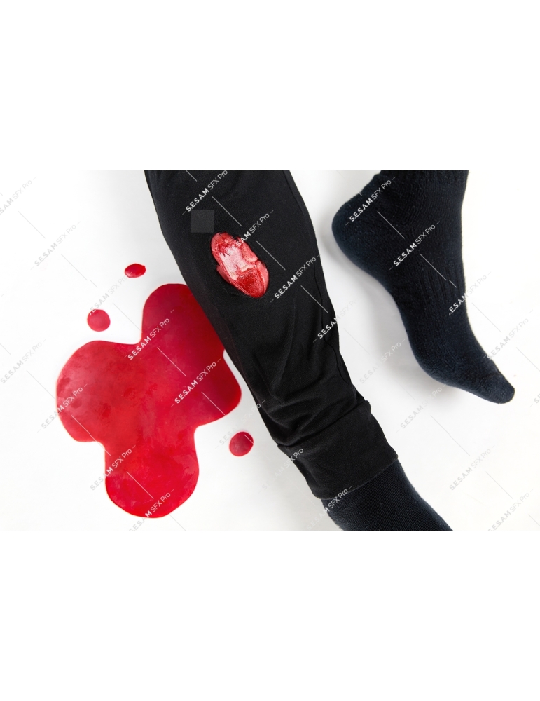 Fracture ouverte du tibia