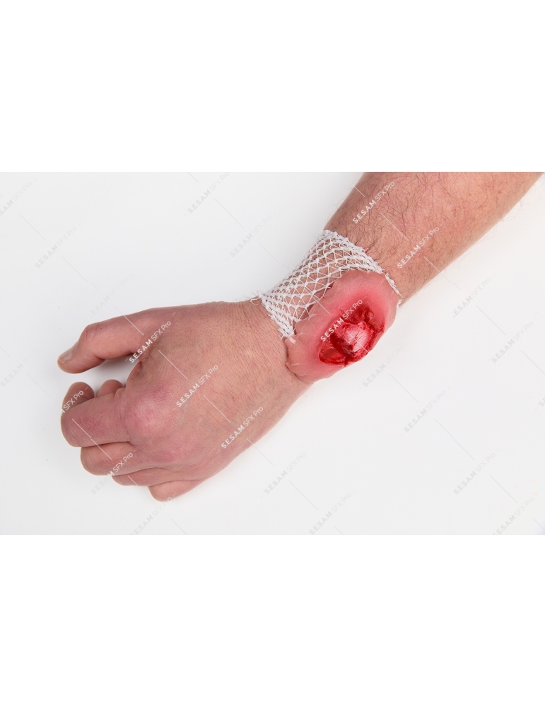 Fracture ouverte du poignet