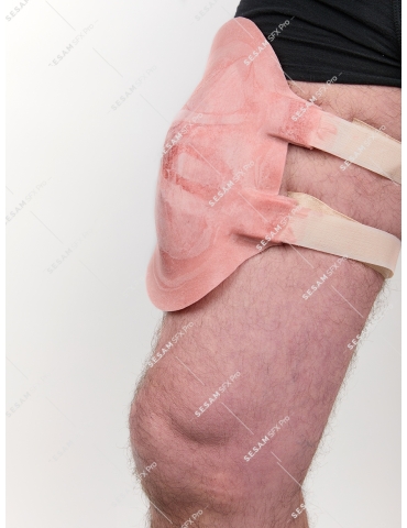 Fracture du femur 2