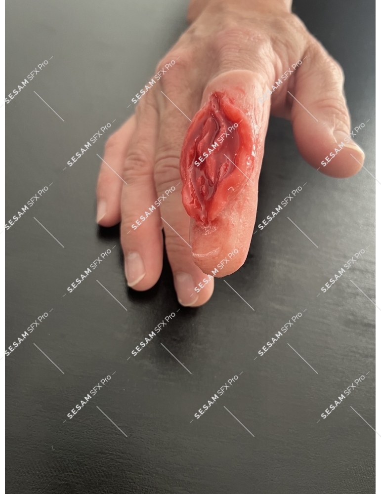 Doigt écrasé